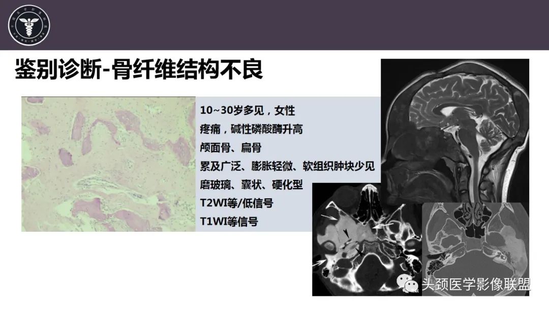 影像PPT - 【病例】斜坡区骨巨细胞瘤 VS 脊索瘤-31