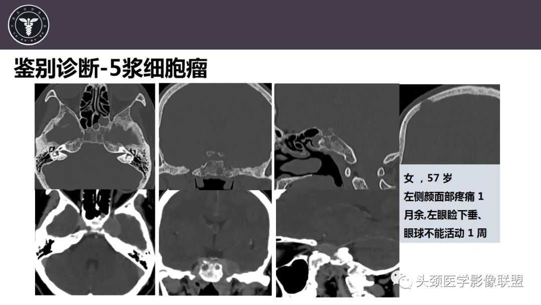 影像PPT - 【病例】斜坡区骨巨细胞瘤 VS 脊索瘤-32