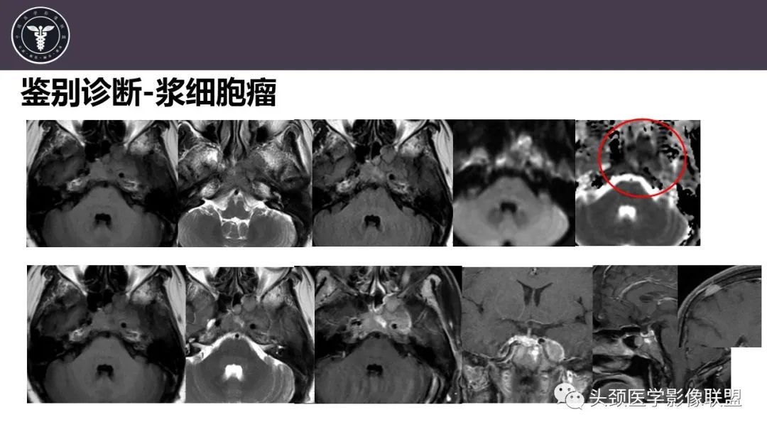 影像PPT - 【病例】斜坡区骨巨细胞瘤 VS 脊索瘤-33