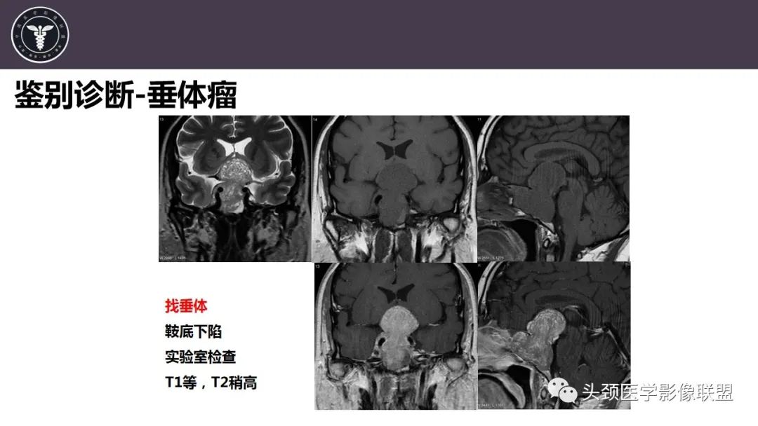 影像PPT - 【病例】斜坡区骨巨细胞瘤 VS 脊索瘤-35