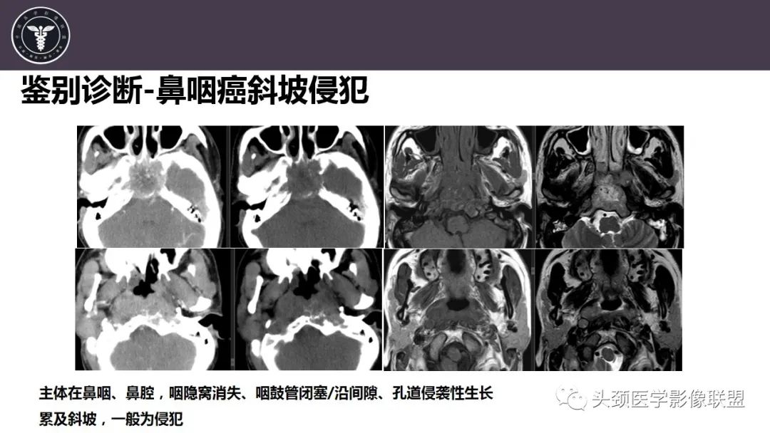 影像PPT - 【病例】斜坡区骨巨细胞瘤 VS 脊索瘤-37