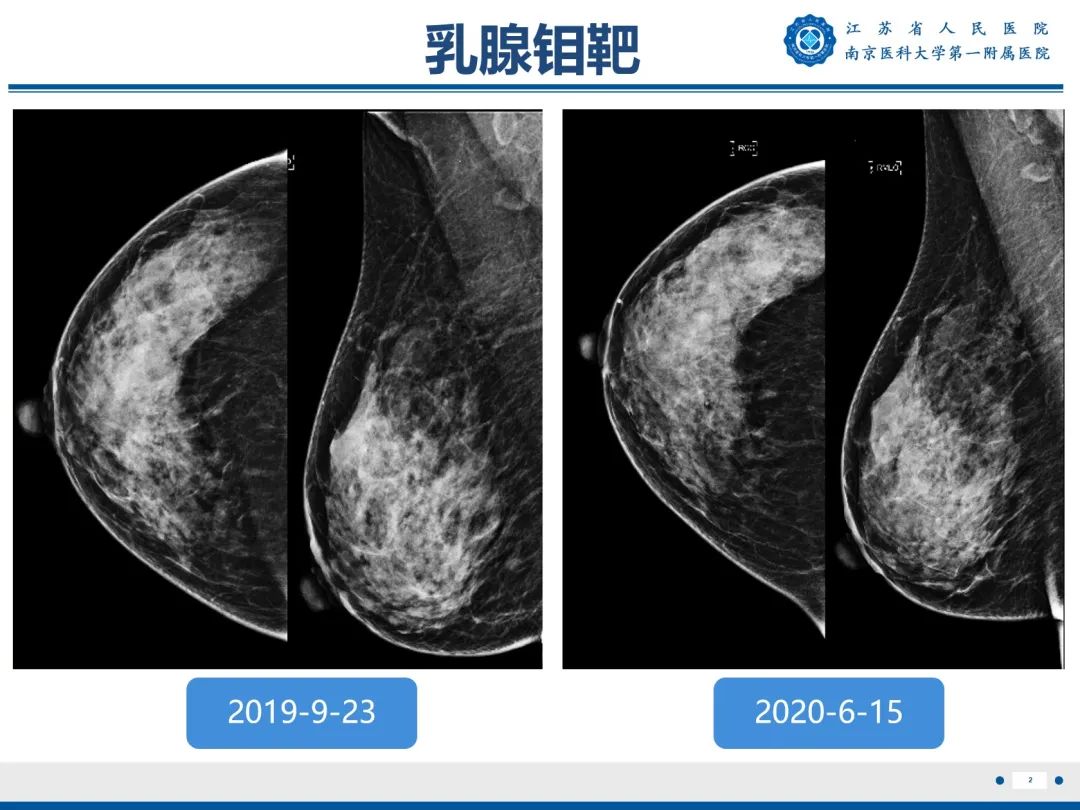 影像PPT - 【PPT】导管原位癌-3