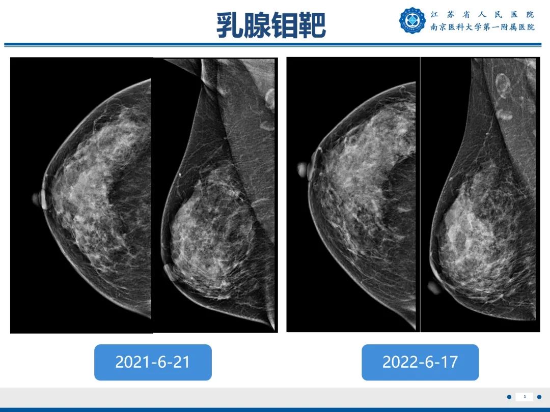 影像PPT - 【PPT】导管原位癌-4