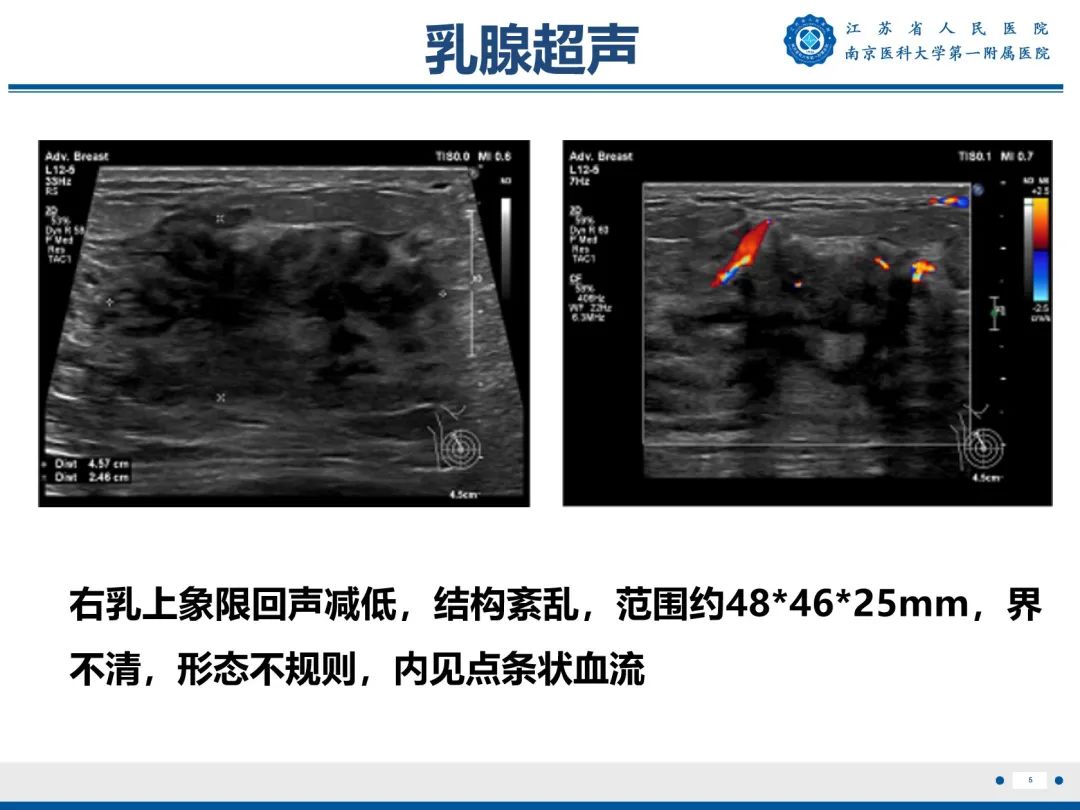 影像PPT - 【PPT】导管原位癌-6