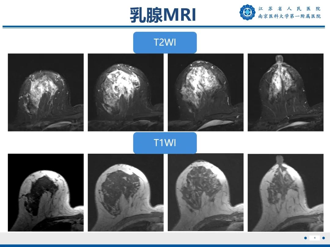 影像PPT - 【PPT】导管原位癌-7