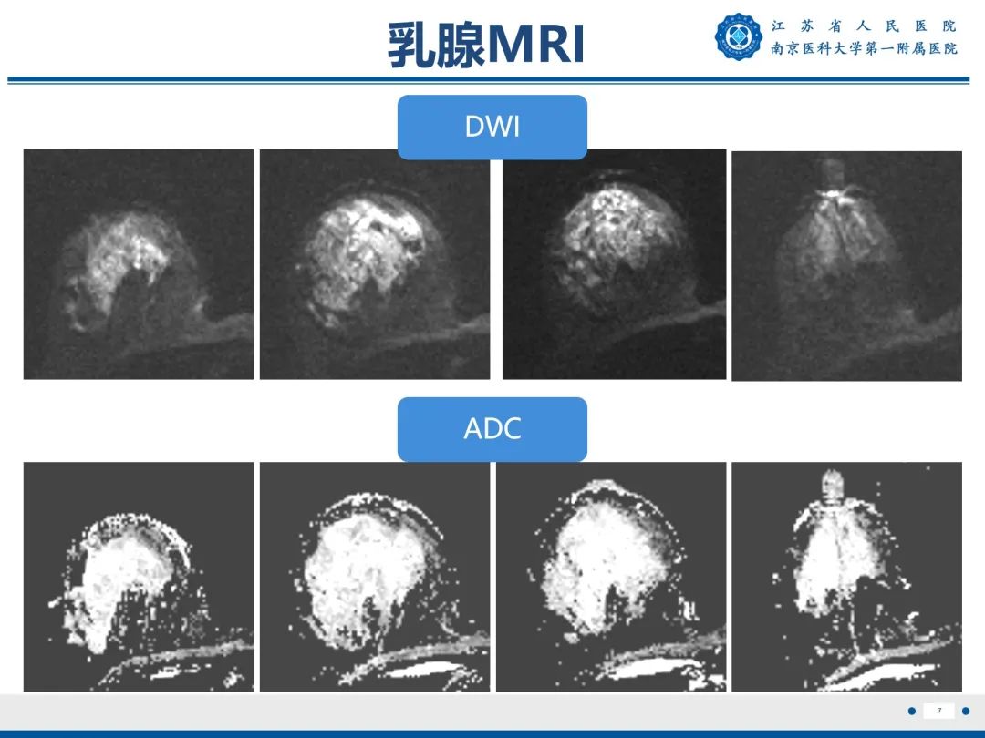 影像PPT - 【PPT】导管原位癌-8