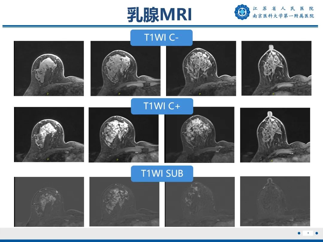 影像PPT - 【PPT】导管原位癌-9