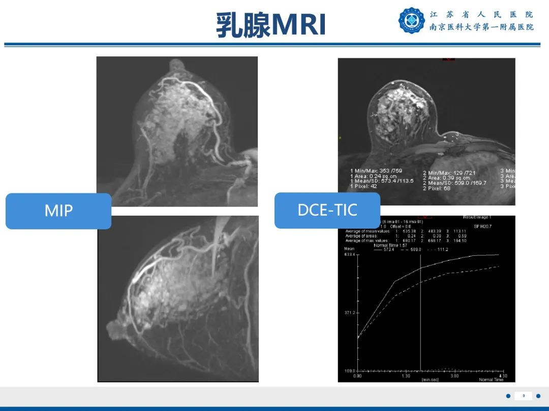 影像PPT - 【PPT】导管原位癌-10