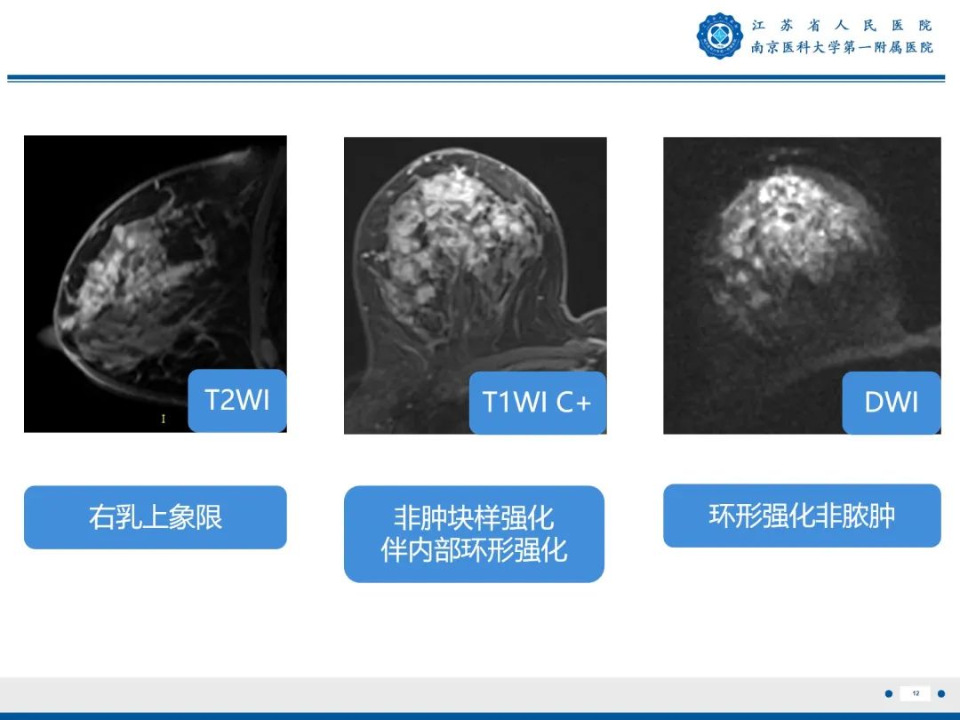 影像PPT - 【PPT】导管原位癌-13