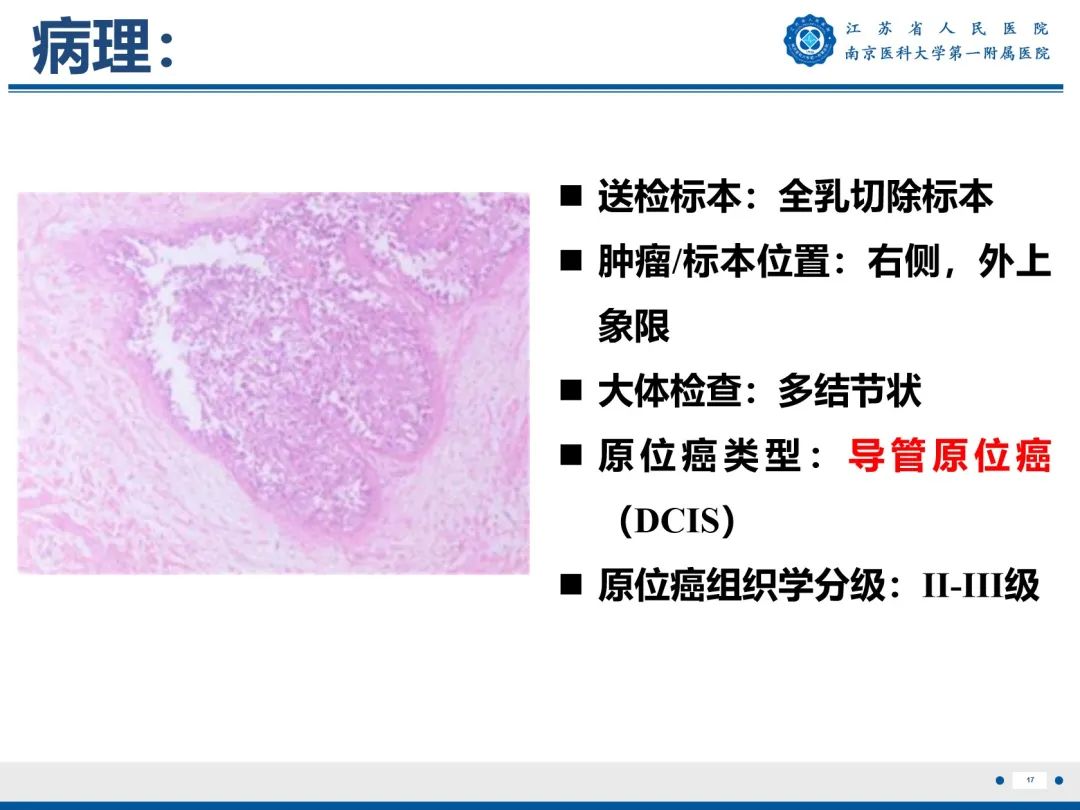 影像PPT - 【PPT】导管原位癌-18