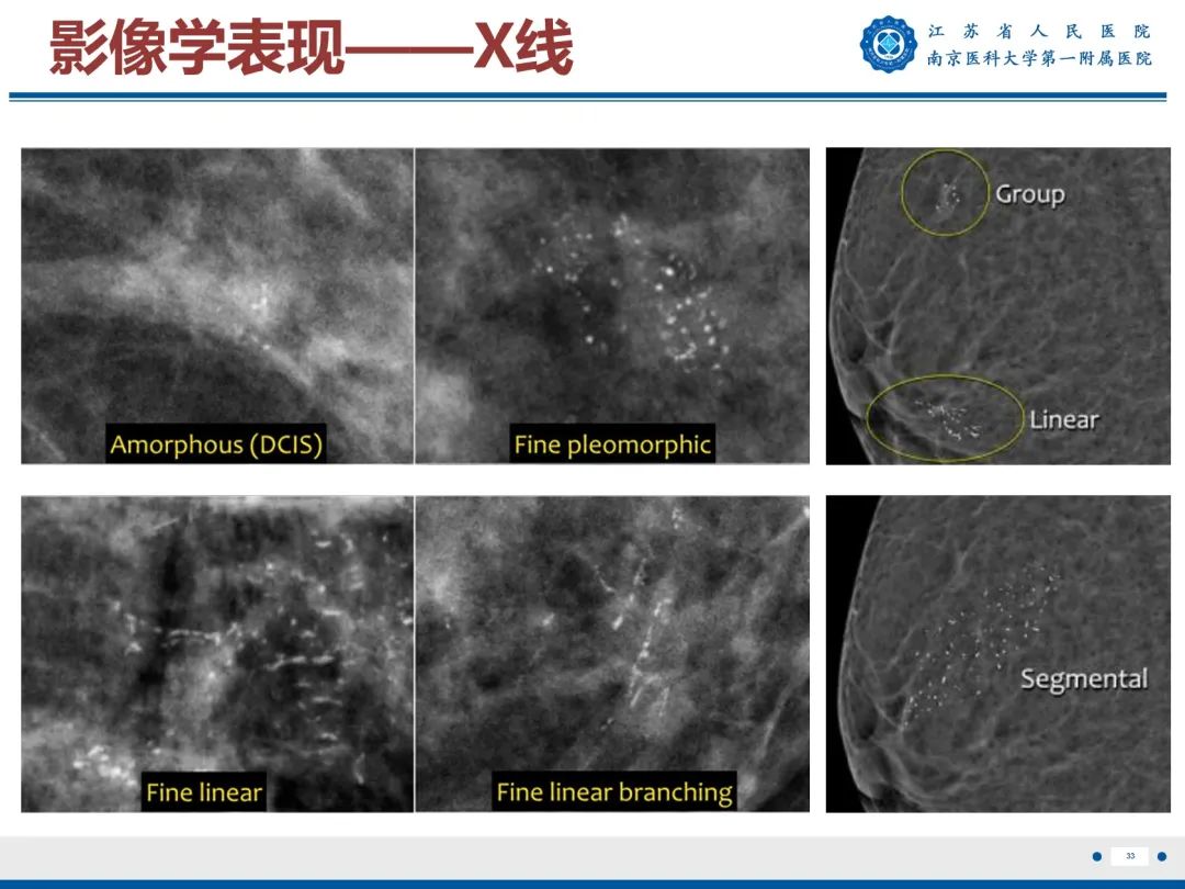 影像PPT - 【PPT】导管原位癌-34