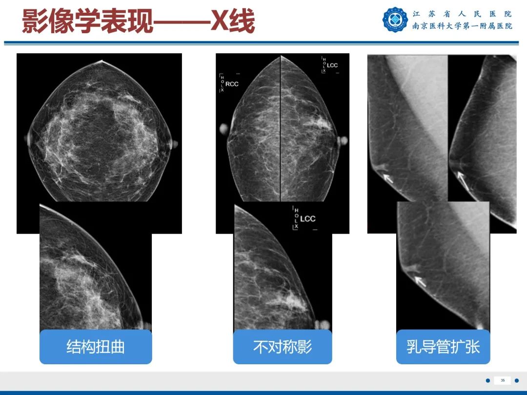 影像PPT - 【PPT】导管原位癌-36