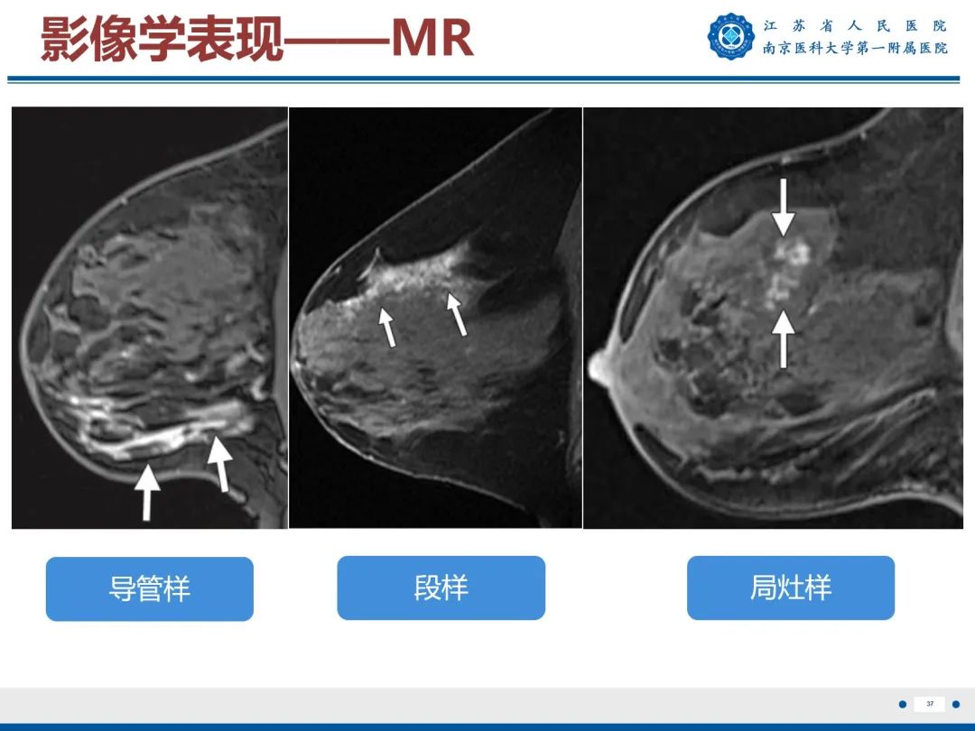 影像PPT - 【PPT】导管原位癌-38