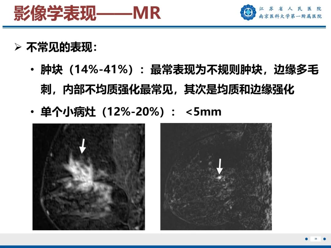 影像PPT - 【PPT】导管原位癌-39