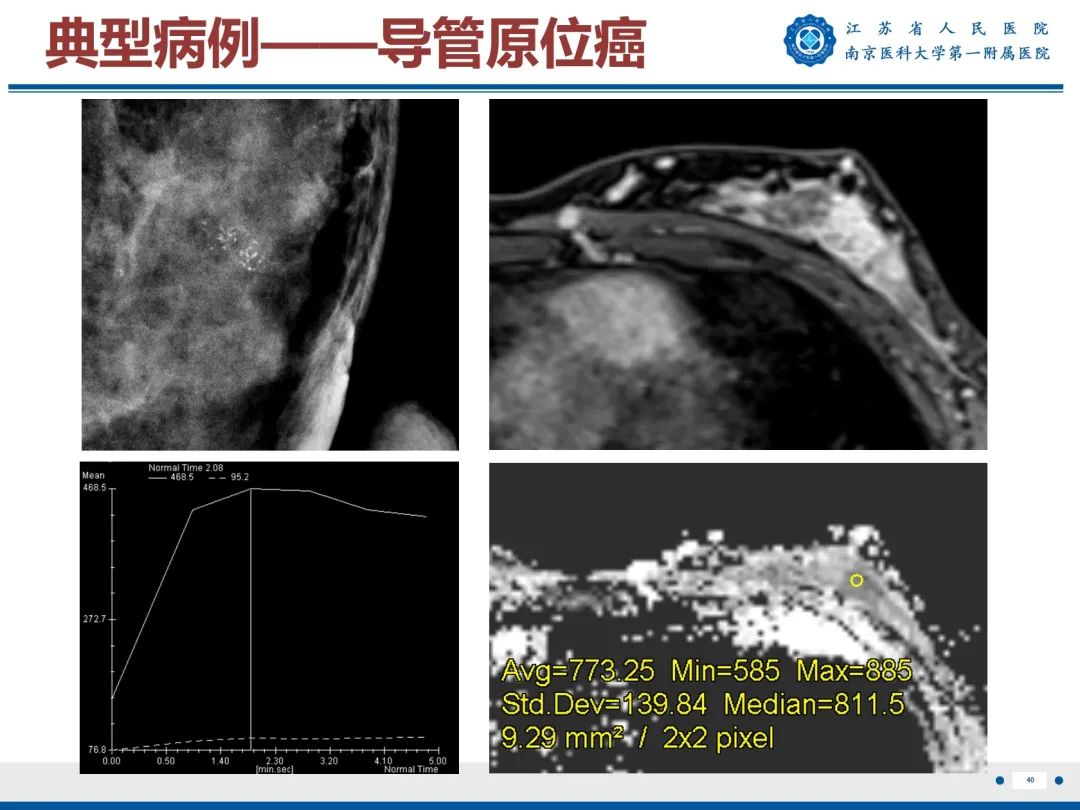 影像PPT - 【PPT】导管原位癌-41