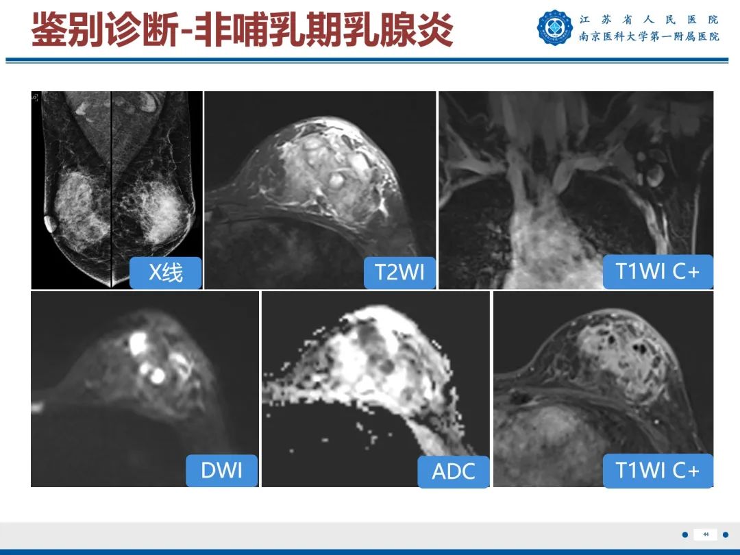 影像PPT - 【PPT】导管原位癌-45
