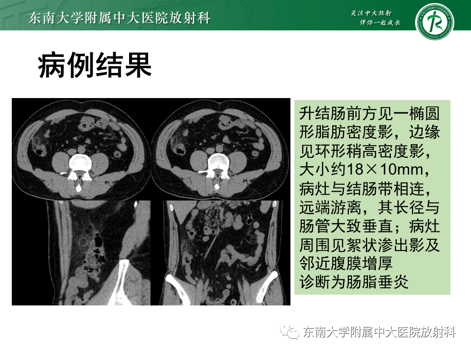 影像PPT - 【PPT】肠脂垂炎-2