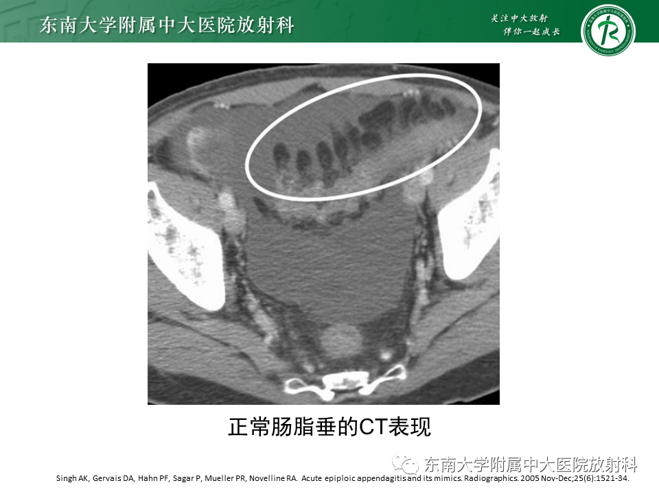 影像PPT - 【PPT】肠脂垂炎-5