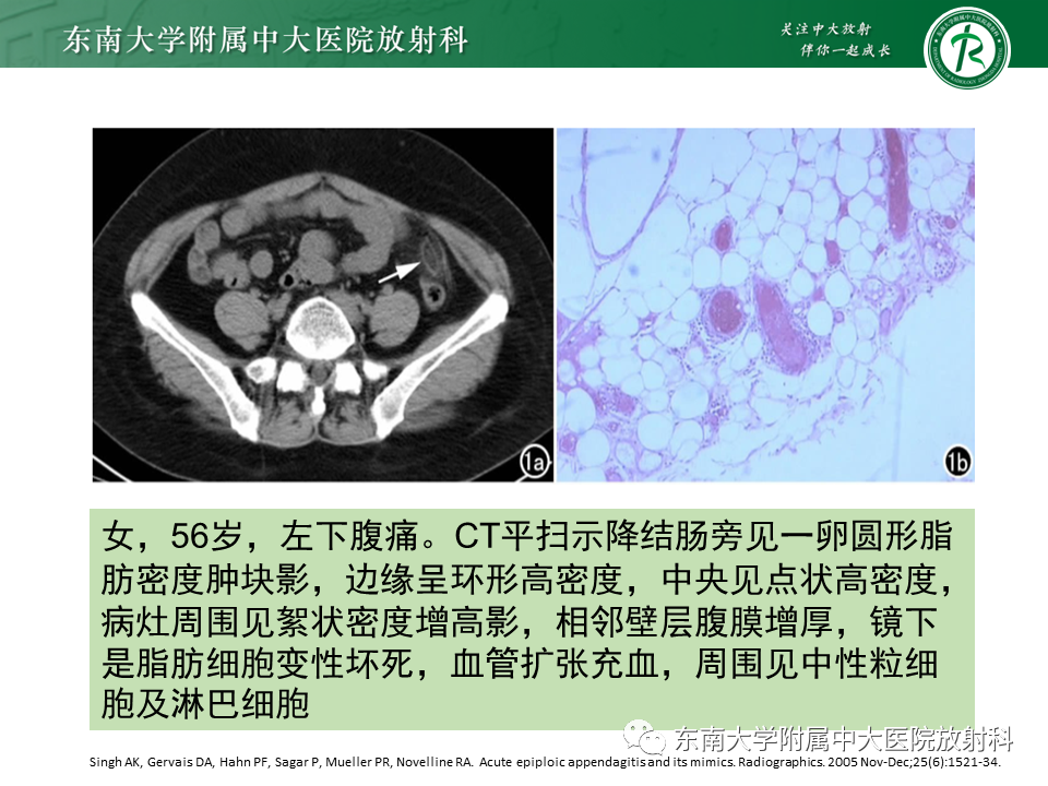 影像PPT - 【PPT】肠脂垂炎-12