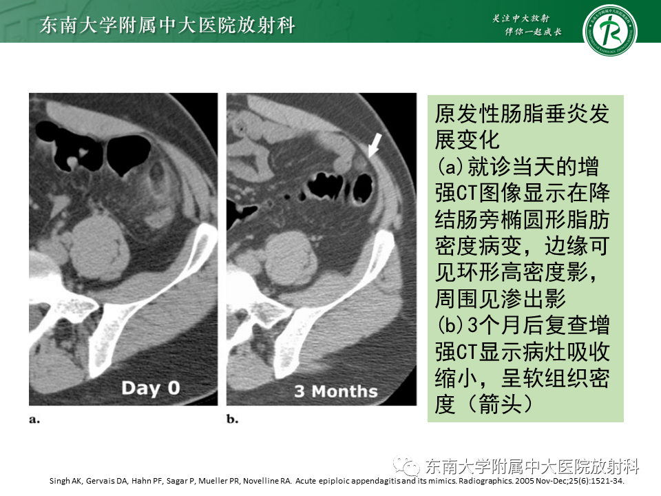 影像PPT - 【PPT】肠脂垂炎-13