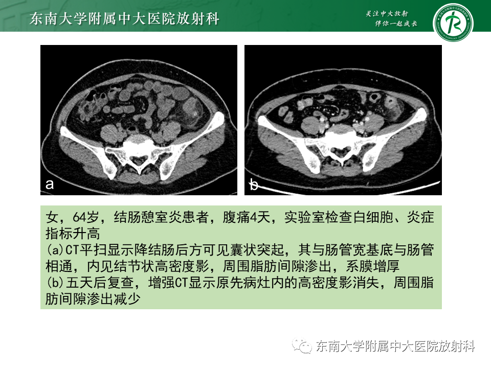 影像PPT - 【PPT】肠脂垂炎-17