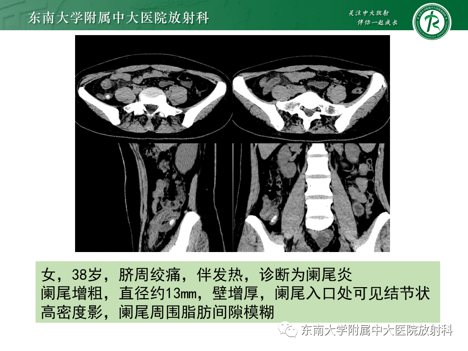 影像PPT - 【PPT】肠脂垂炎-20
