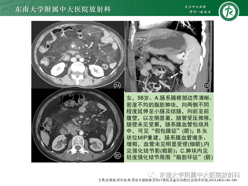 影像PPT - 【PPT】肠脂垂炎-23