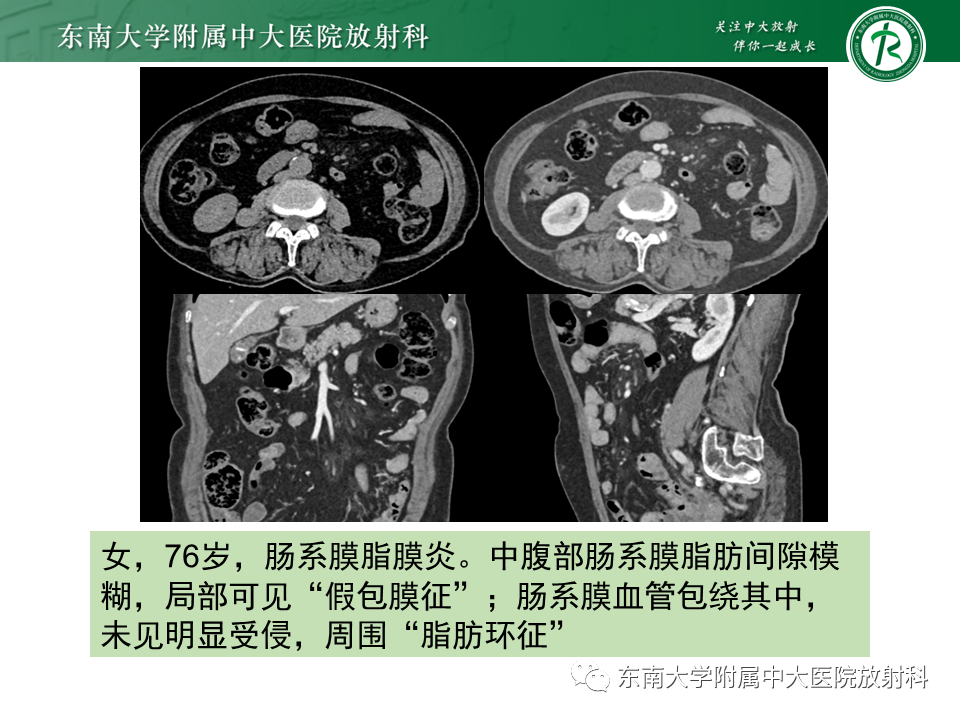 影像PPT - 【PPT】肠脂垂炎-24