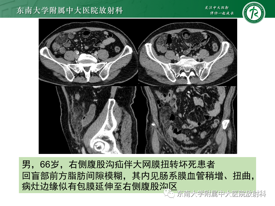 影像PPT - 【PPT】肠脂垂炎-28