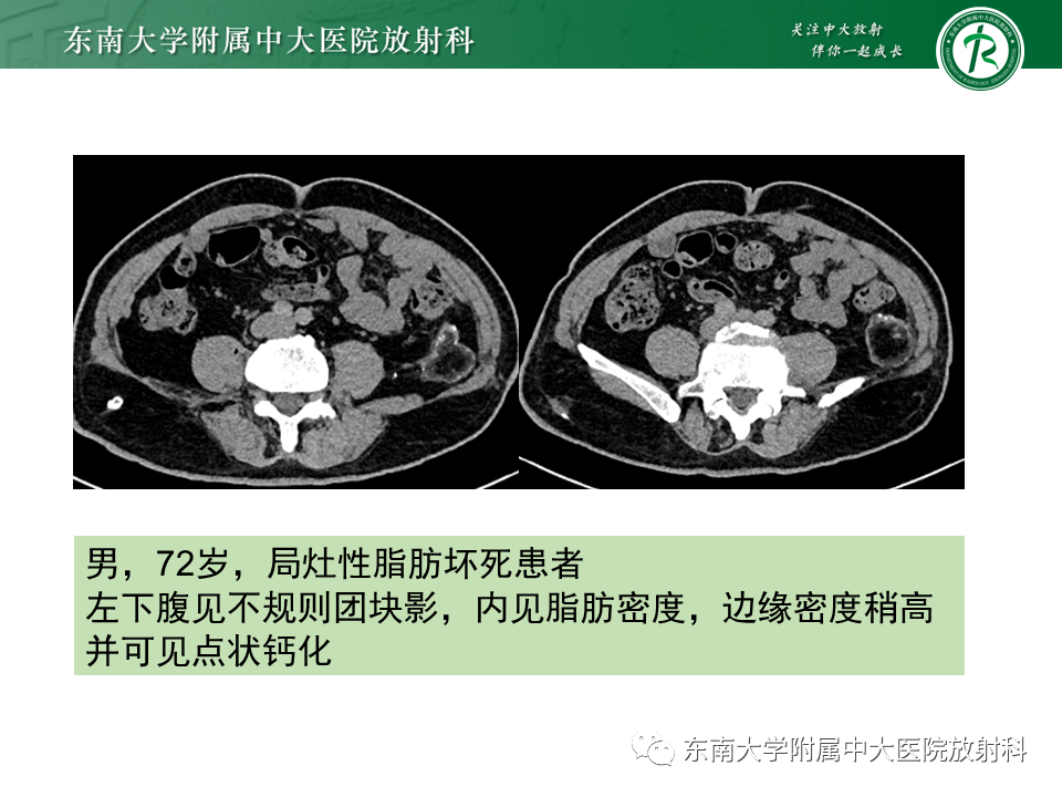 影像PPT - 【PPT】肠脂垂炎-30