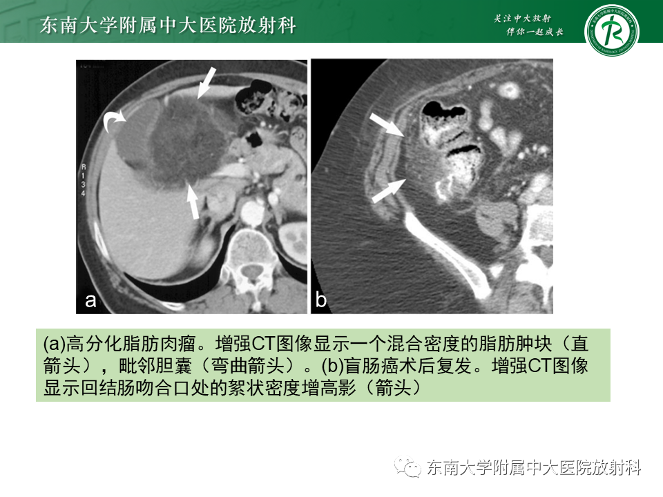 影像PPT - 【PPT】肠脂垂炎-32