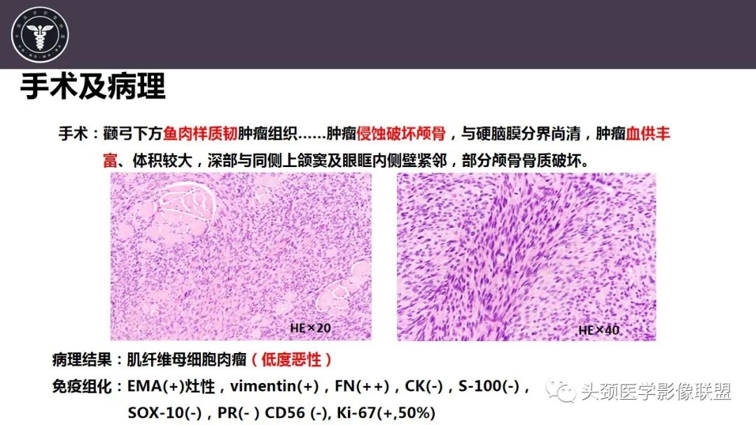 影像PPT - 【病例】咬肌间隙肌纤维母细胞肉瘤1例MR诊断与鉴别-9