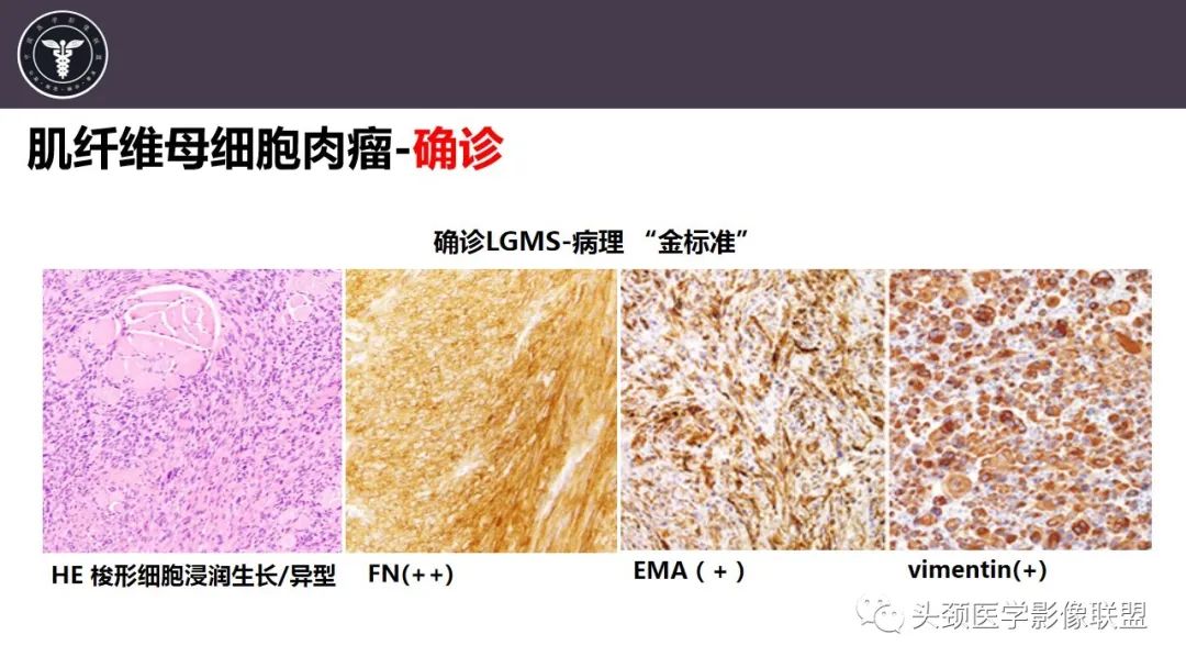 影像PPT - 【病例】咬肌间隙肌纤维母细胞肉瘤1例MR诊断与鉴别-13