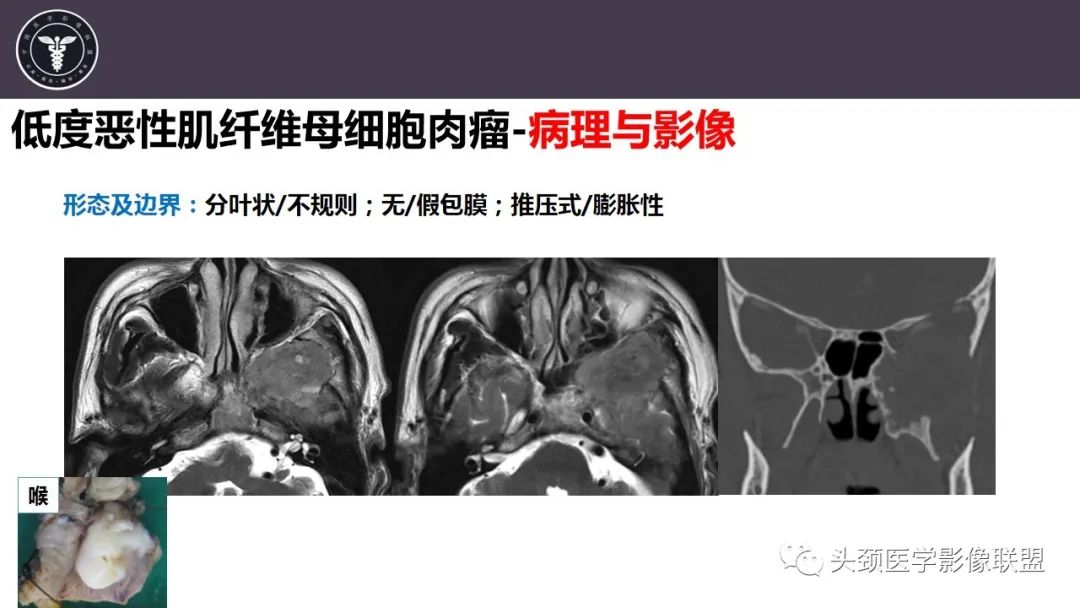 影像PPT - 【病例】咬肌间隙肌纤维母细胞肉瘤1例MR诊断与鉴别-14