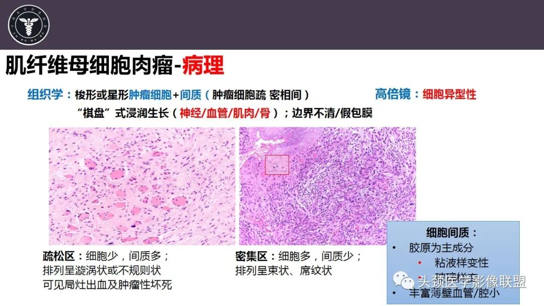 影像PPT - 【病例】咬肌间隙肌纤维母细胞肉瘤1例MR诊断与鉴别-15