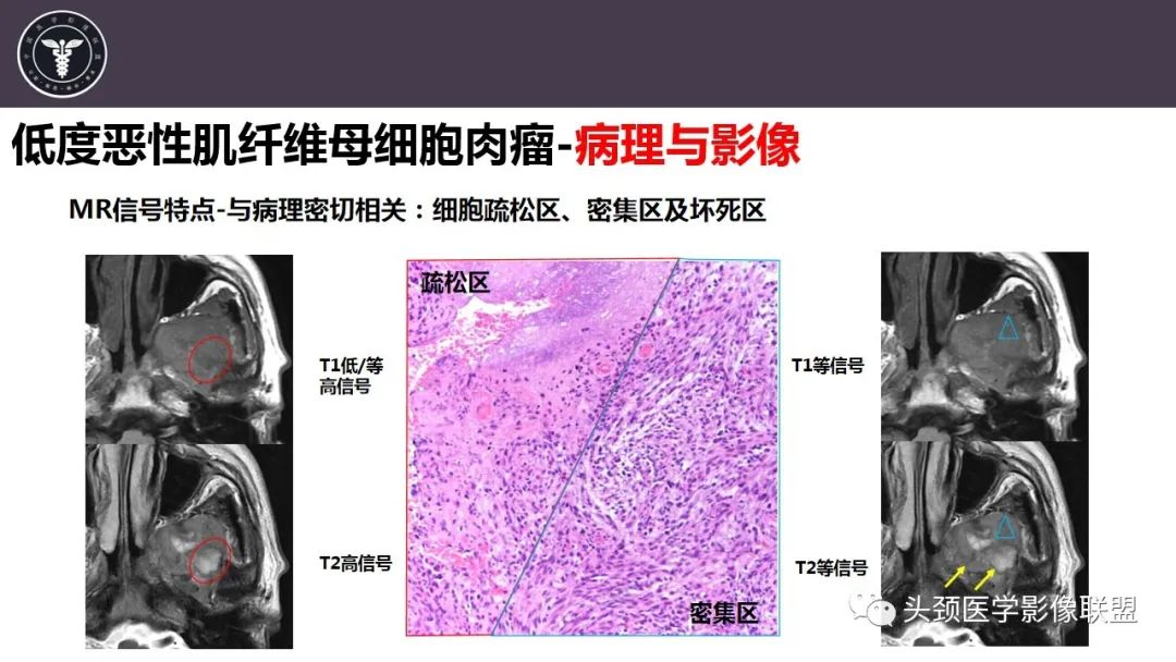 影像PPT - 【病例】咬肌间隙肌纤维母细胞肉瘤1例MR诊断与鉴别-16