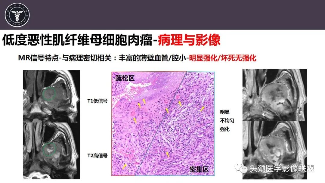 影像PPT - 【病例】咬肌间隙肌纤维母细胞肉瘤1例MR诊断与鉴别-17