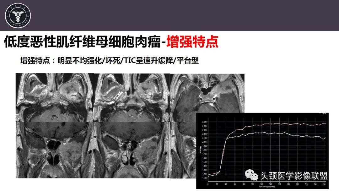 影像PPT - 【病例】咬肌间隙肌纤维母细胞肉瘤1例MR诊断与鉴别-18