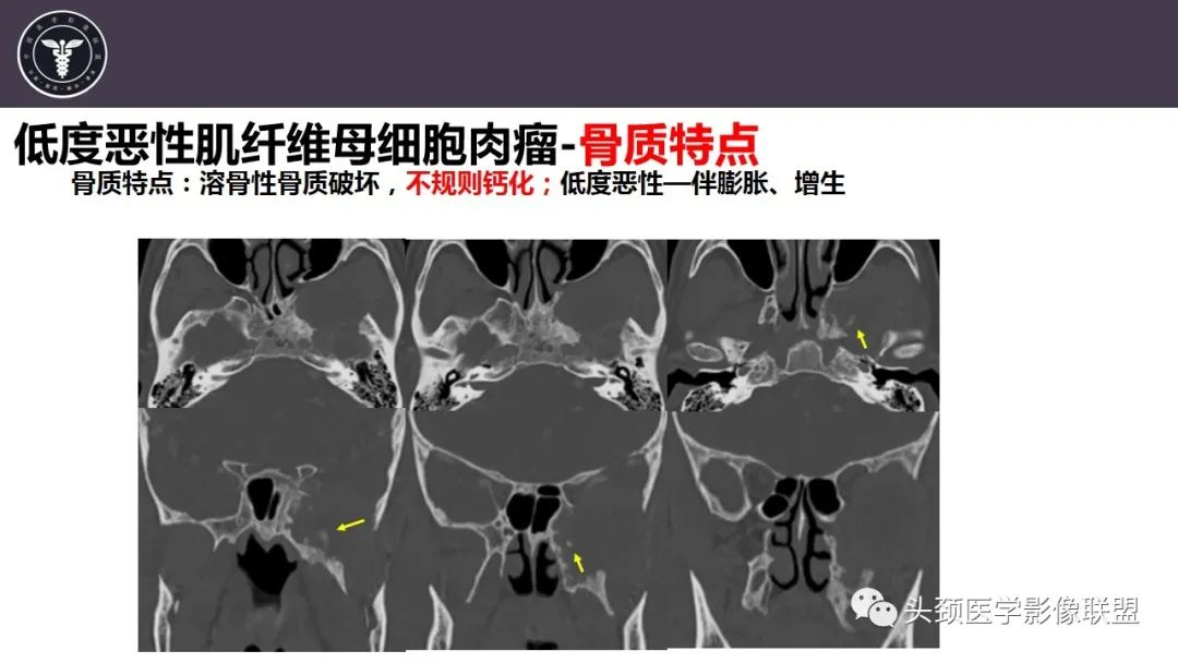 影像PPT - 【病例】咬肌间隙肌纤维母细胞肉瘤1例MR诊断与鉴别-19
