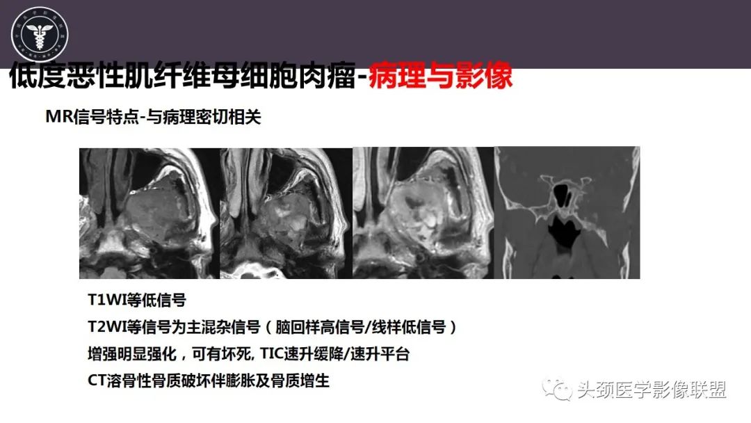 影像PPT - 【病例】咬肌间隙肌纤维母细胞肉瘤1例MR诊断与鉴别-20