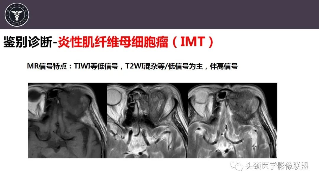 影像PPT - 【病例】咬肌间隙肌纤维母细胞肉瘤1例MR诊断与鉴别-23