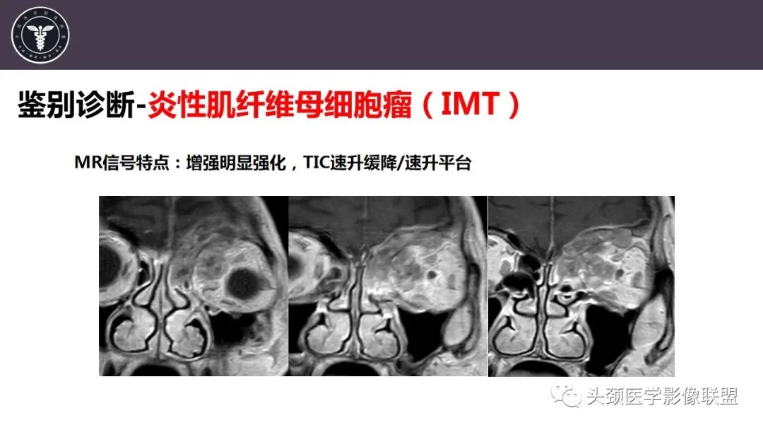 影像PPT - 【病例】咬肌间隙肌纤维母细胞肉瘤1例MR诊断与鉴别-24