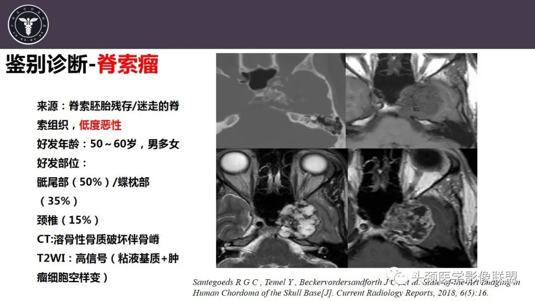 影像PPT - 【病例】咬肌间隙肌纤维母细胞肉瘤1例MR诊断与鉴别-26