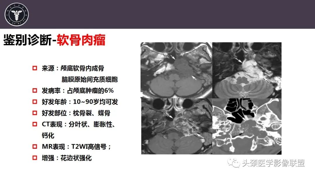 影像PPT - 【病例】咬肌间隙肌纤维母细胞肉瘤1例MR诊断与鉴别-28