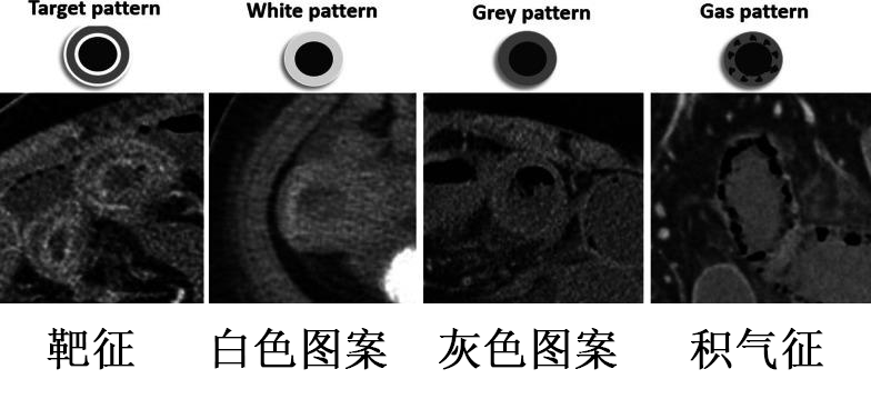 影像PPT - 肠缺血不同时期的影像分期-4 影像PPT - 肠缺血不同时期的影像分期-4