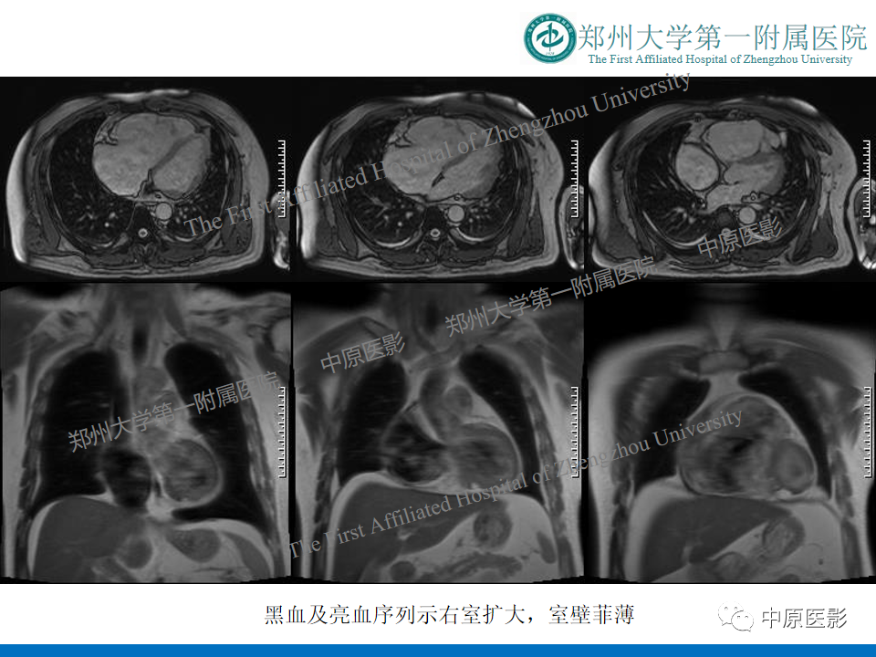 影像PPT - 【病例】致心律失常性右室心肌病1例MR影像-5