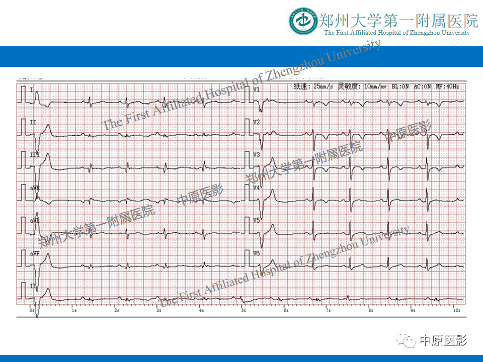 影像PPT - 【病例】致心律失常性右室心肌病1例MR影像-4