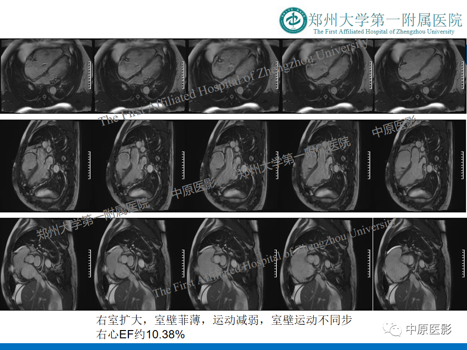 影像PPT - 【病例】致心律失常性右室心肌病1例MR影像-6