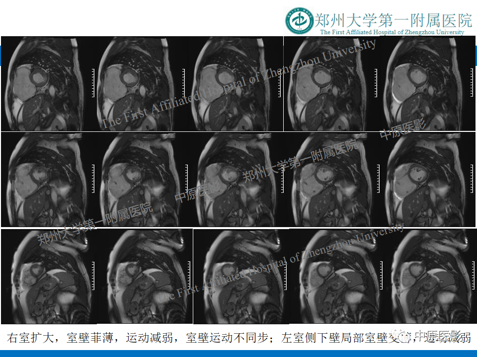 影像PPT - 【病例】致心律失常性右室心肌病1例MR影像-7