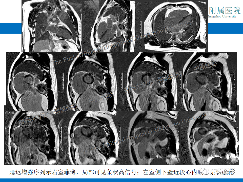 影像PPT - 【病例】致心律失常性右室心肌病1例MR影像-8